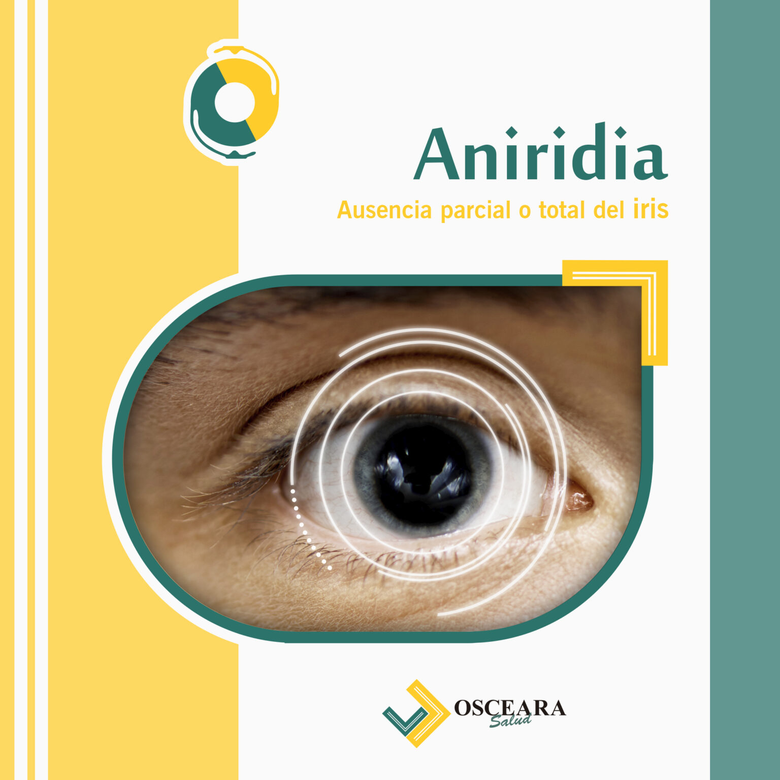 Aniridia - Osceara